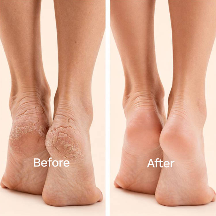 Glycolic & Salicylic Acid Exfoliating Foot Peeling Mask - Reduces Dry Skin